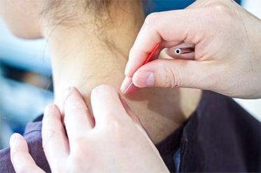 鍼灸(はりきゅう)施術